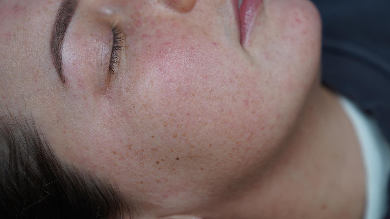 Before treatment result 1
