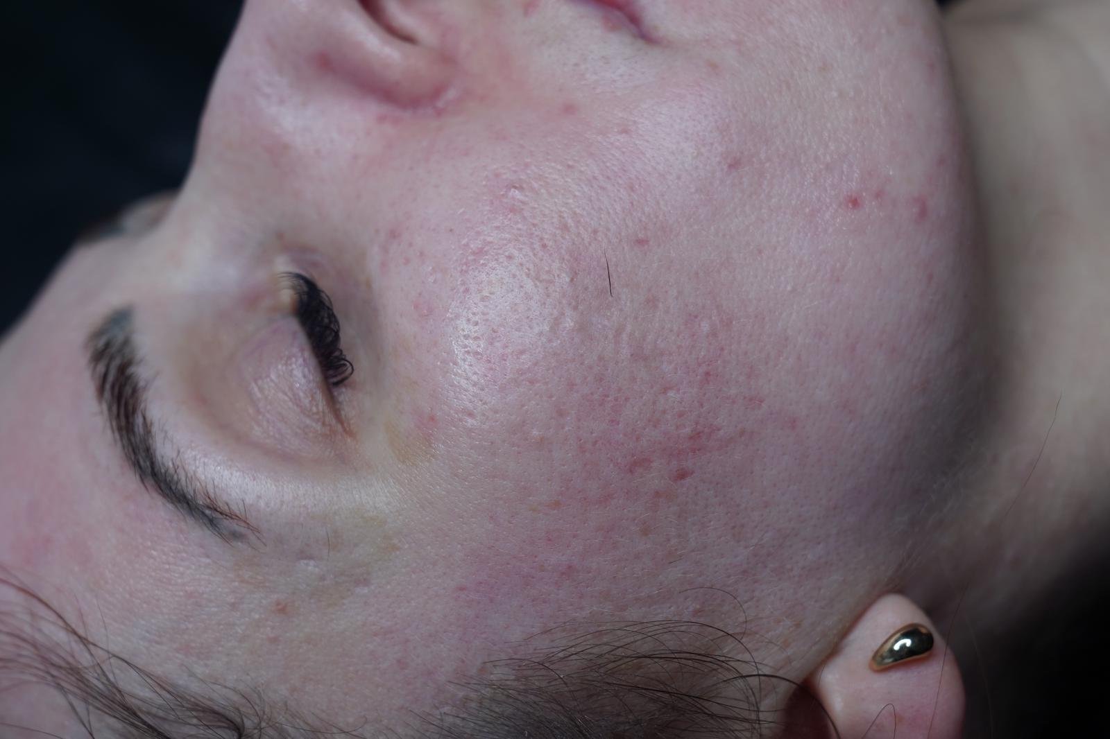 Before treatment result 2